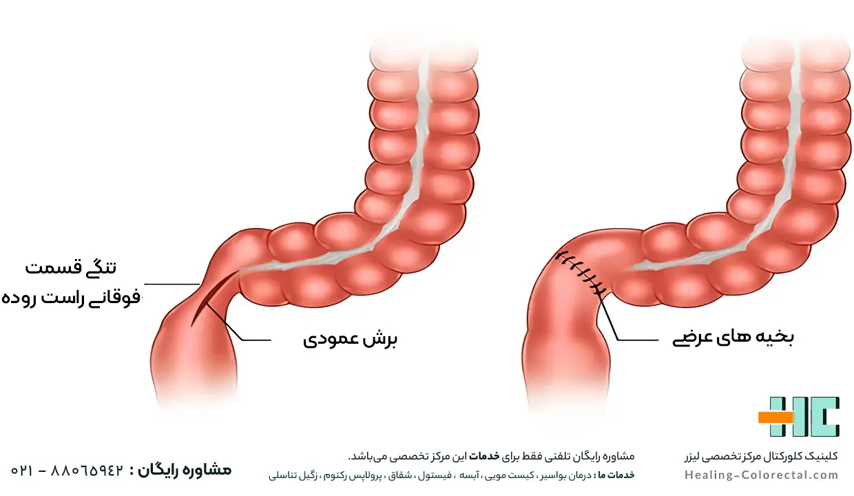 درمان مقعد تنگ