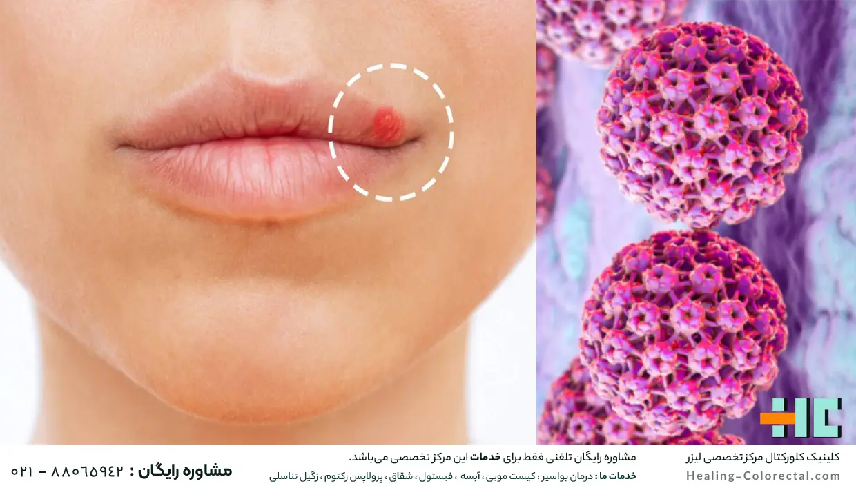 زگیل تناسلی ویروس HPV چیست