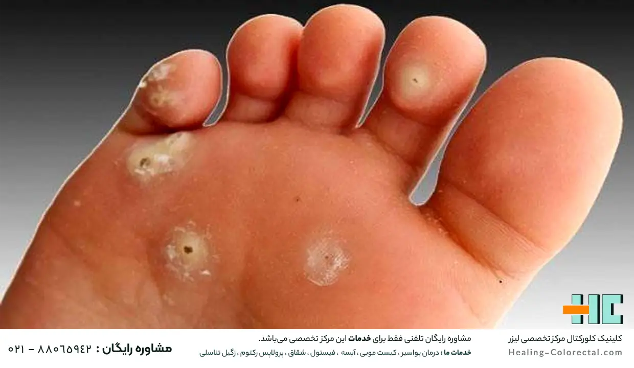 زگیل کف پا یا میخچه