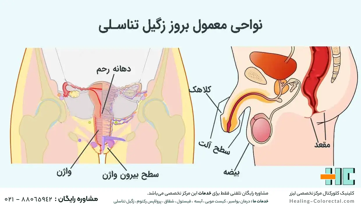 انواع زگیل تناسلی
