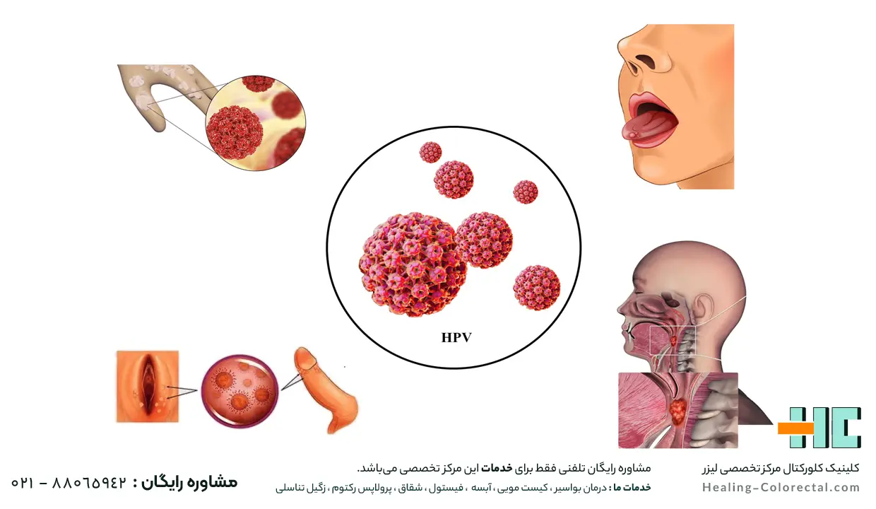 راه های انتقال ویروس hpv
