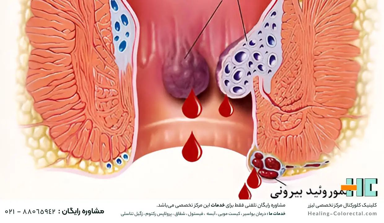 تشخیص بواسیر خونی در خانه