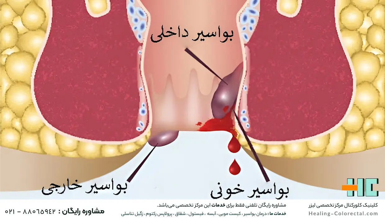 درمان بواسیر خونی در خانه