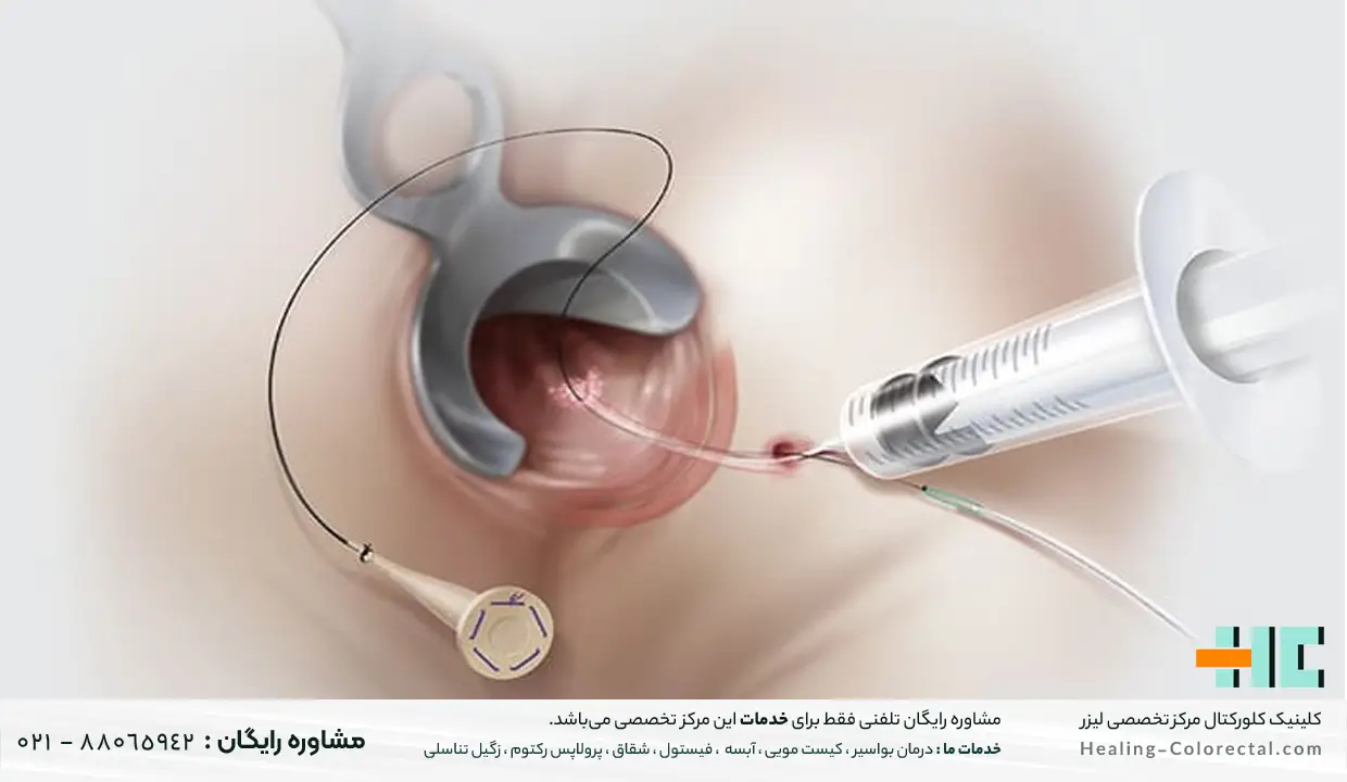 انواع روش های عمل فیستول