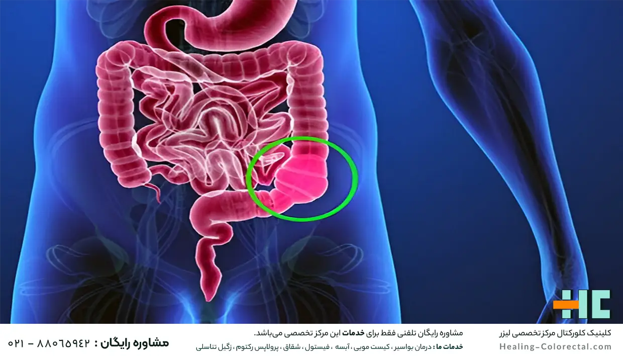 یبوست چیست؟