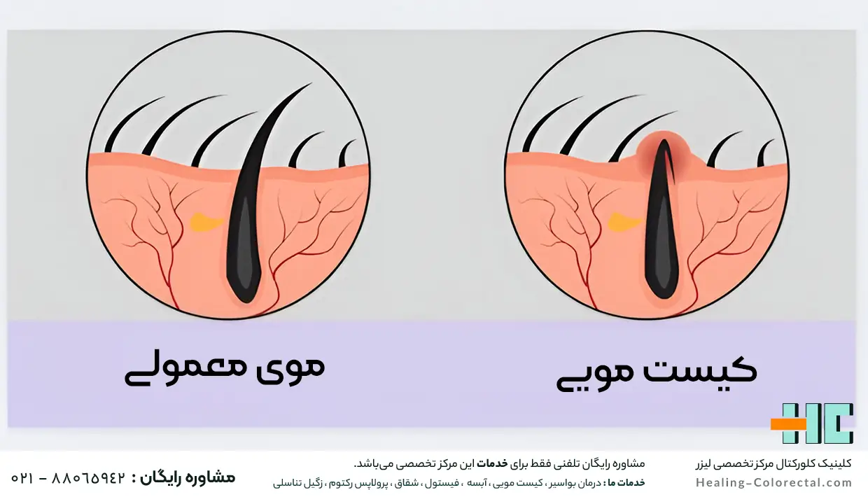 سینوس پیلونیدال چیست