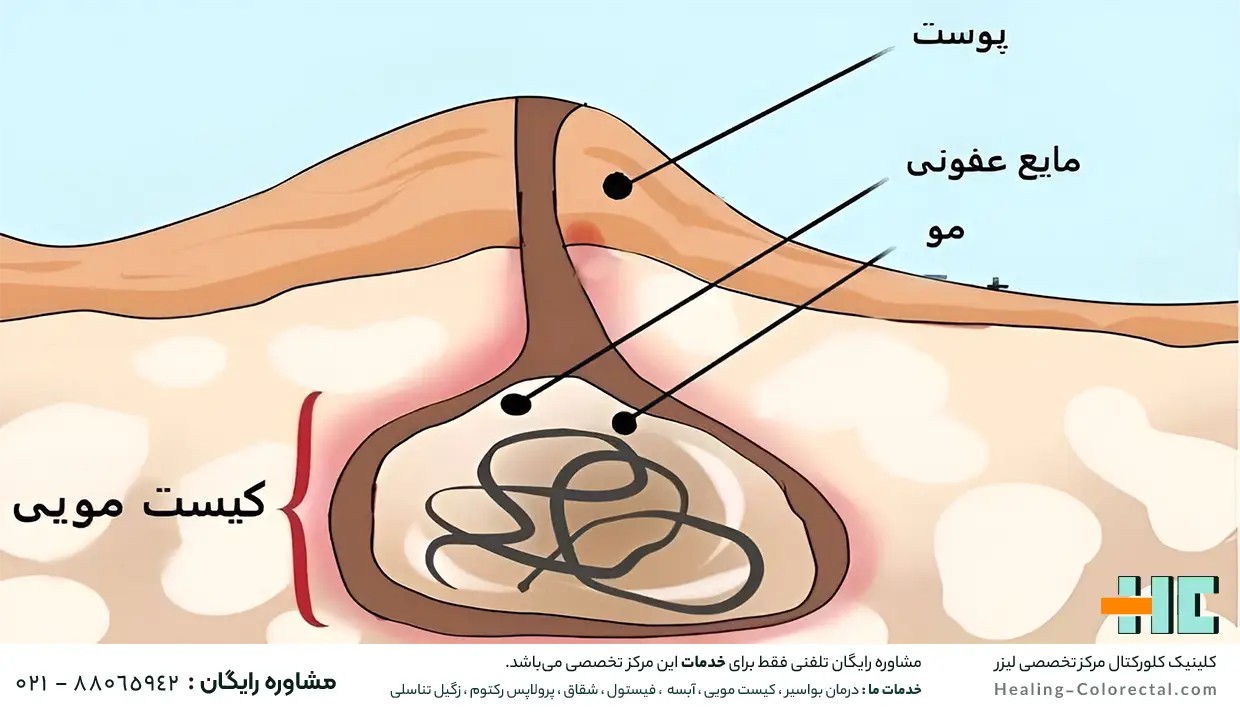 علائم کیست مویی