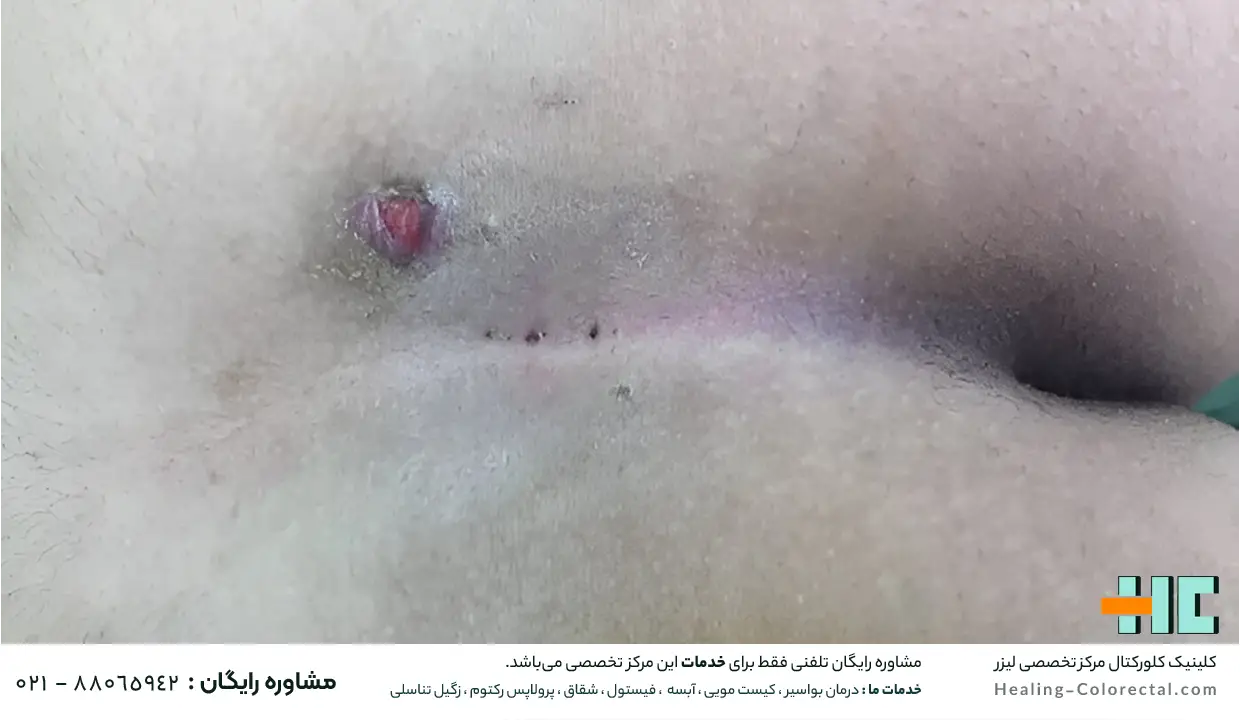 دلایل عود کیست مویی بعد از جراحی