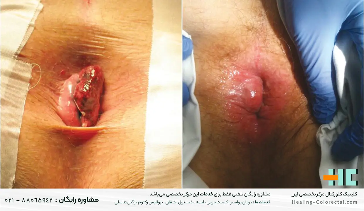 عکس بواسیر خارجی و بیرون زده