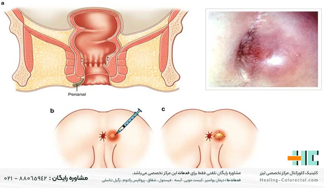 بواسیر و ورم مقعد