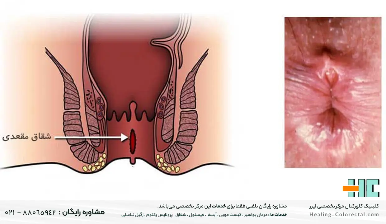 شقاق در کدام ناحیه از مقعد دیده می شود