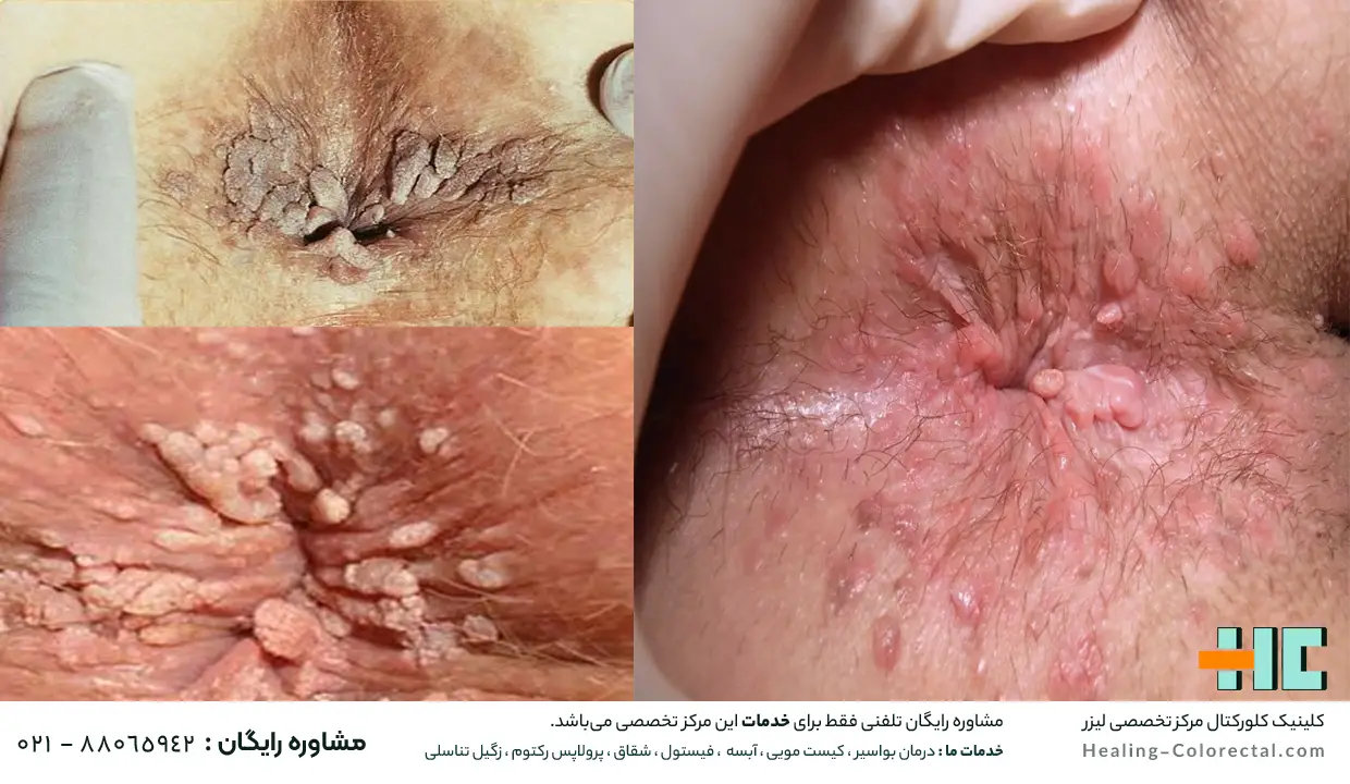 ظاهر و عکس زگیل مقعدی 