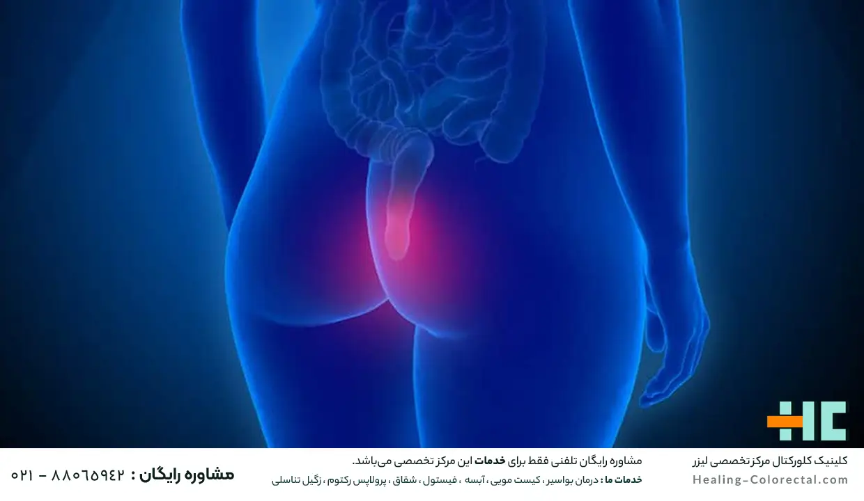 مراقبت بعد از جراحی شقاق با لیزر در تهران