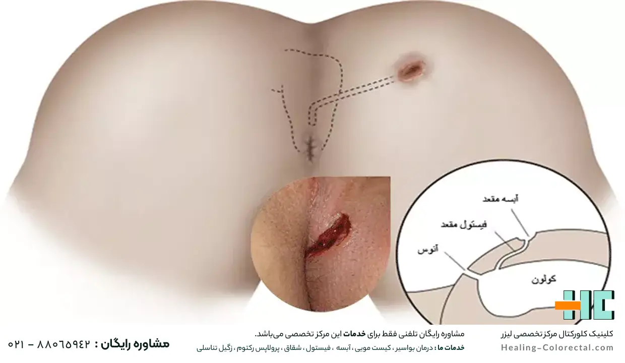 انواع فیستول مقعدی