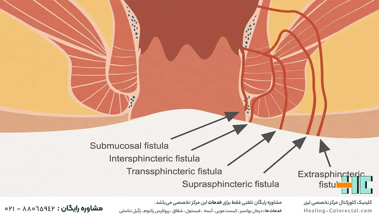 انواع فیستول مقعدی 