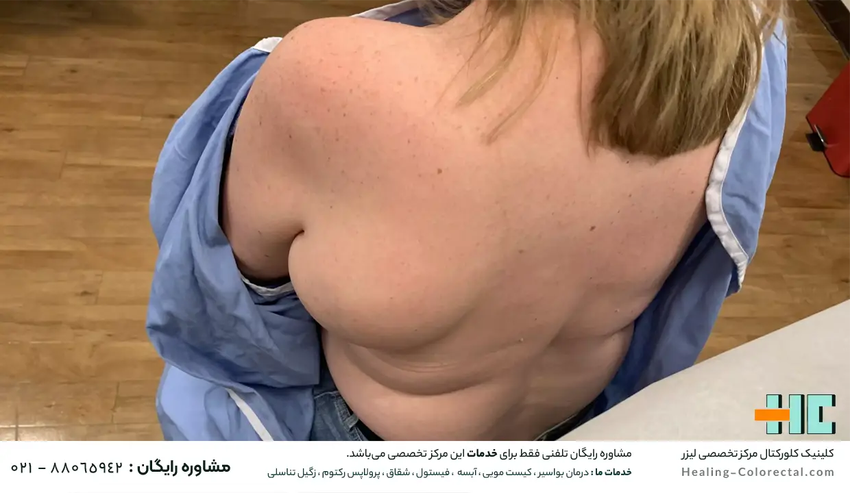 چه زمانی برای درمان لیپوم یا غده چربی باید به پزشک مراجعه کرد؟