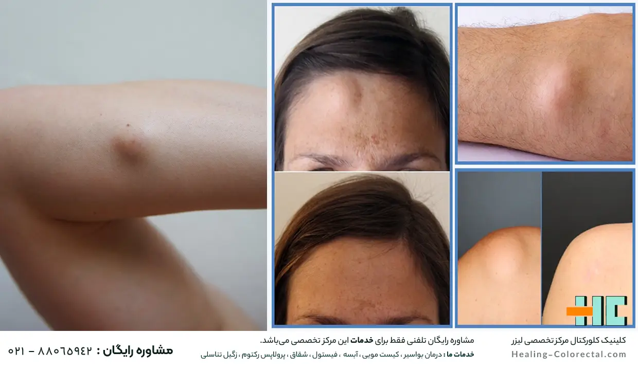 بهترین درمان غده چربی یا لیپوم
