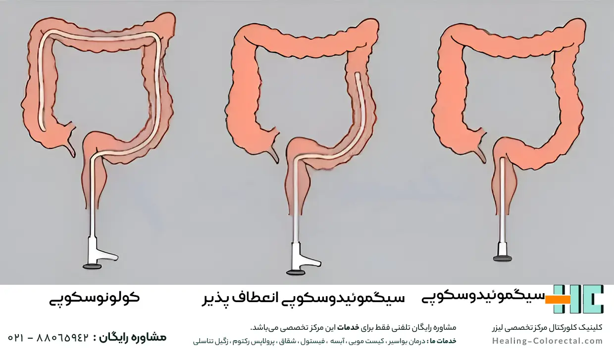 تفاوت سیگموئیدوسکوپی و کولونوسکوپی
