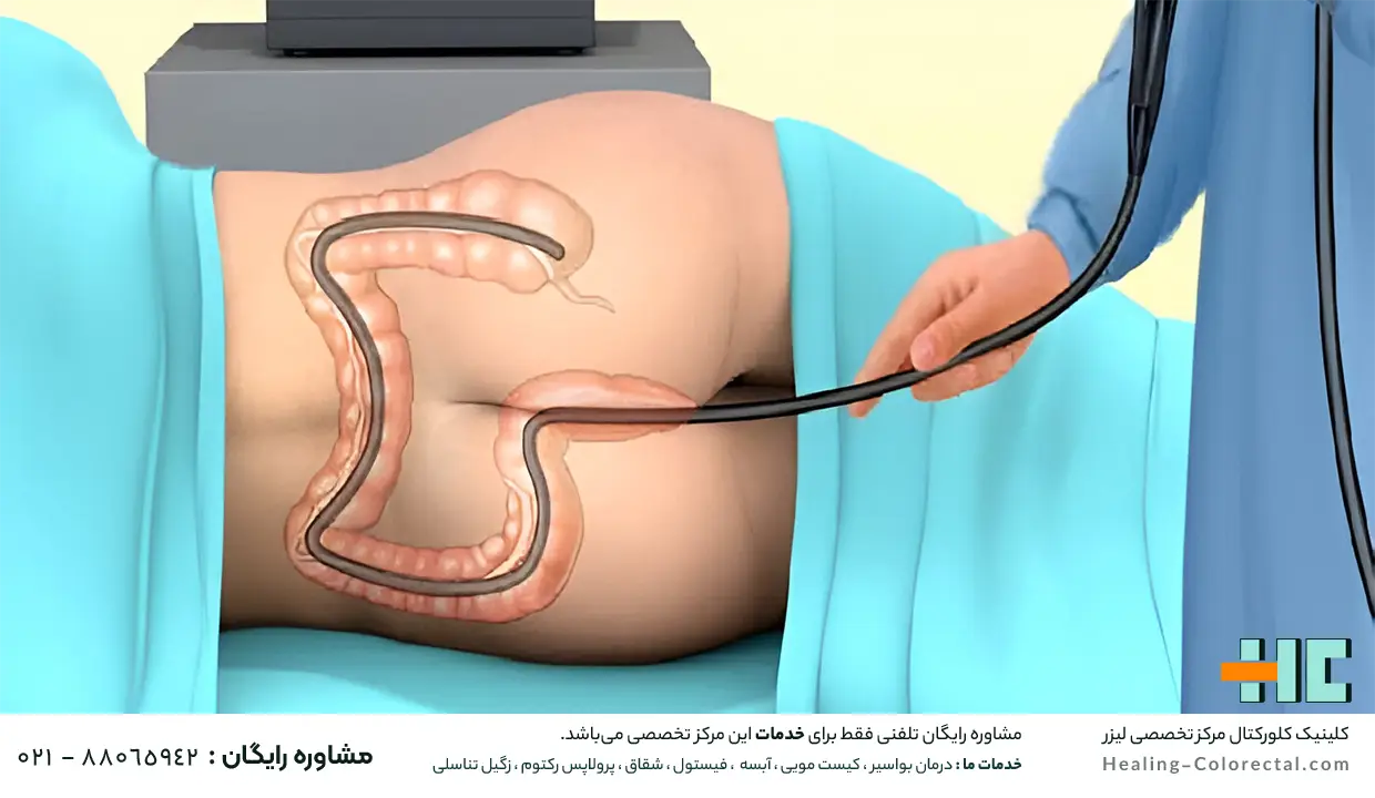 کولون سیگوئید چیست و کجاست؟

