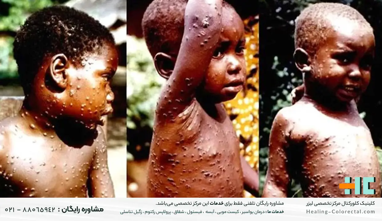 چه افرادی در معرض خطر ابتلا به آبله میمون هستند 